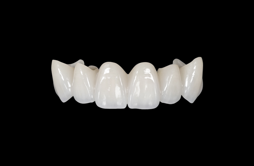 Porcelain-Veneered Zirconia